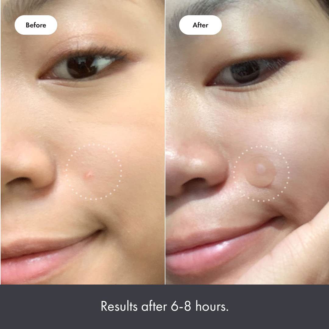 ACNE PATCHES