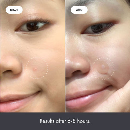ACNE PATCHES